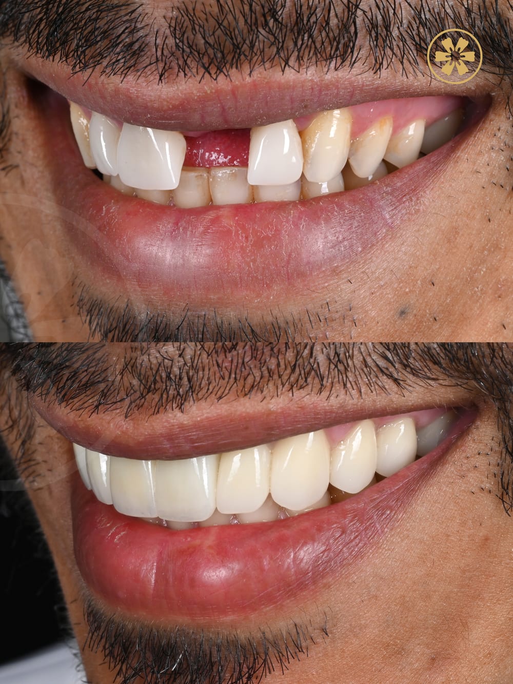 Before and after smile photo from a patient at Creative Arts Dubai