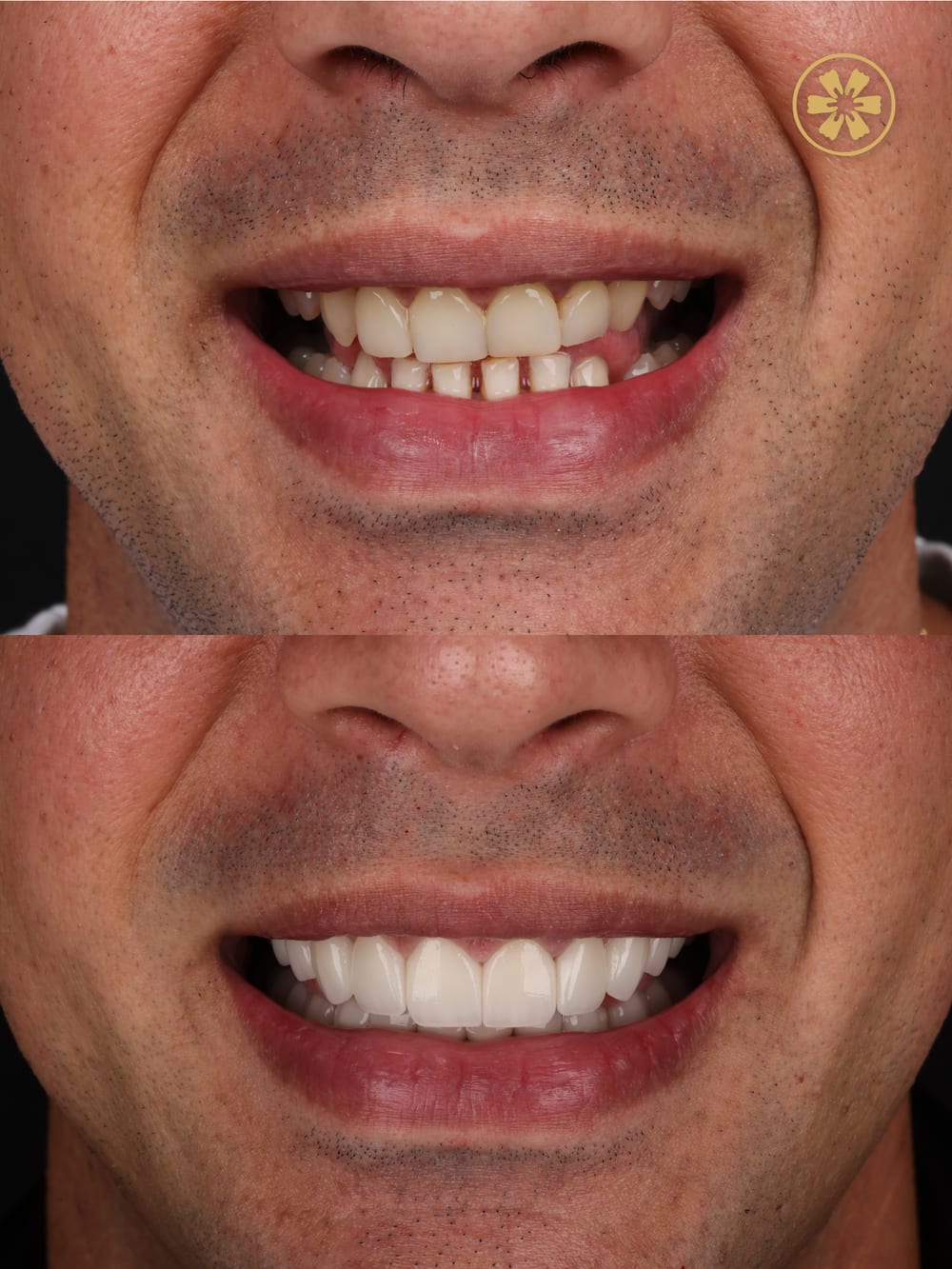 Before and after smile photo from a patient at Creative Arts Dubai
