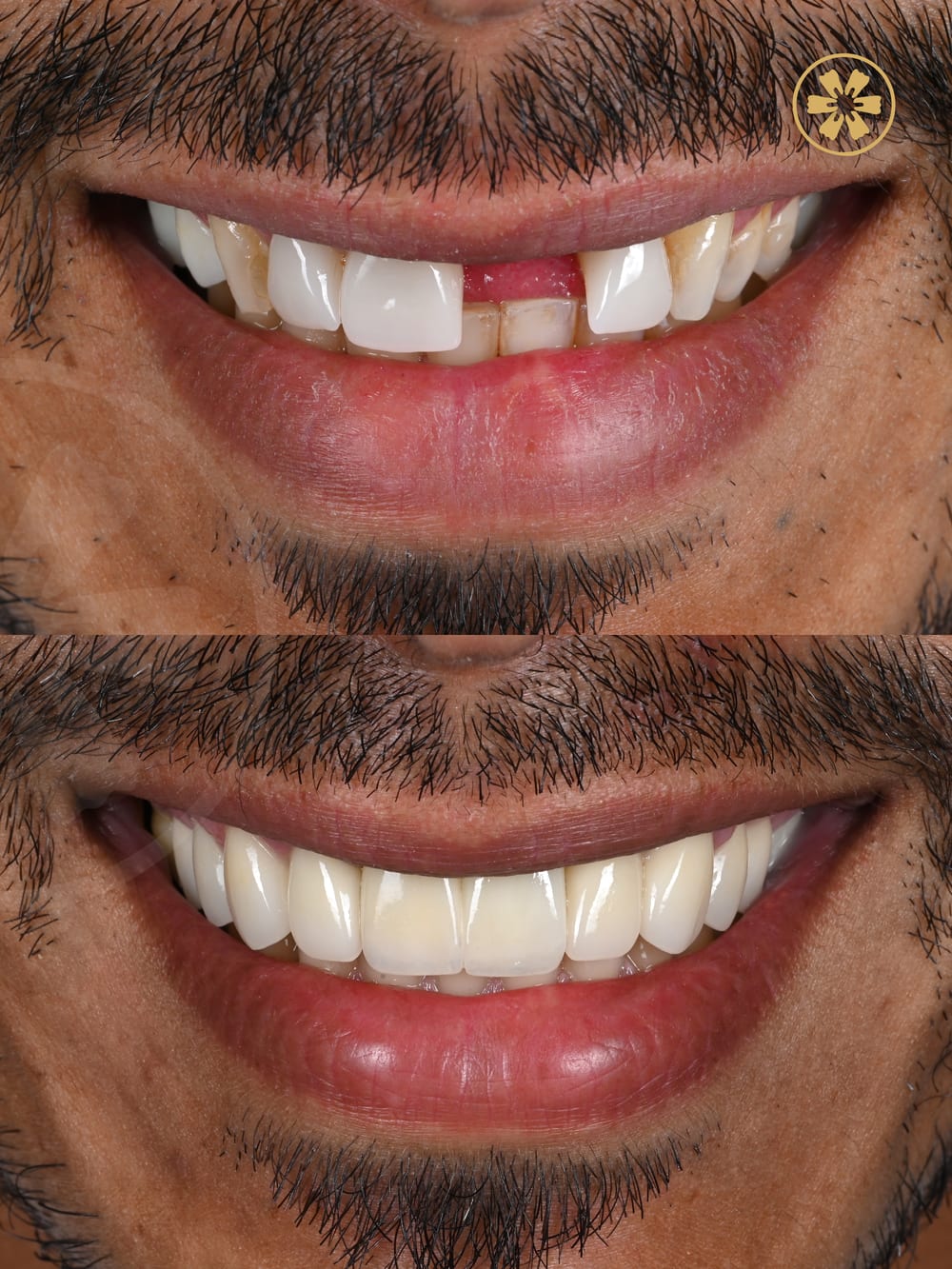 Before and after smile photo from a patient at Creative Arts Dubai