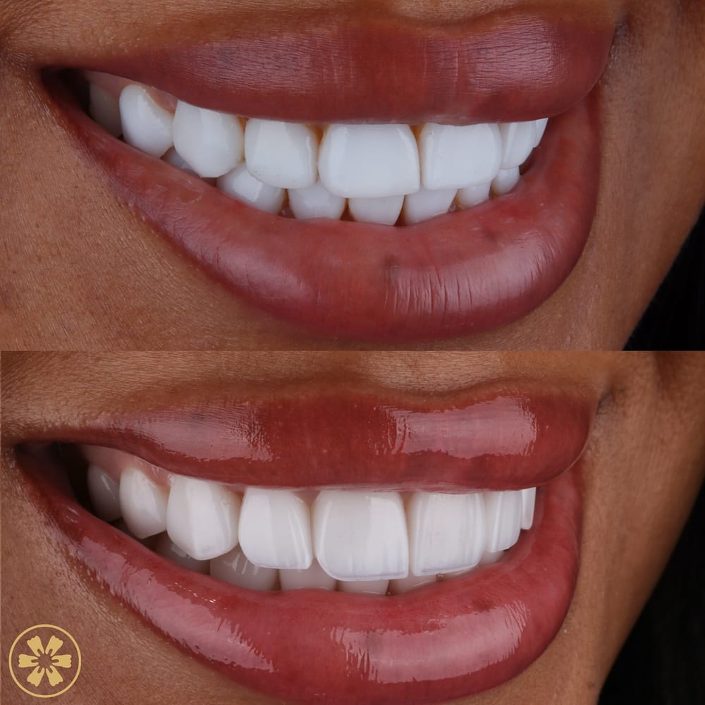 Before and after smile photo from a patient at Creative Arts Dubai