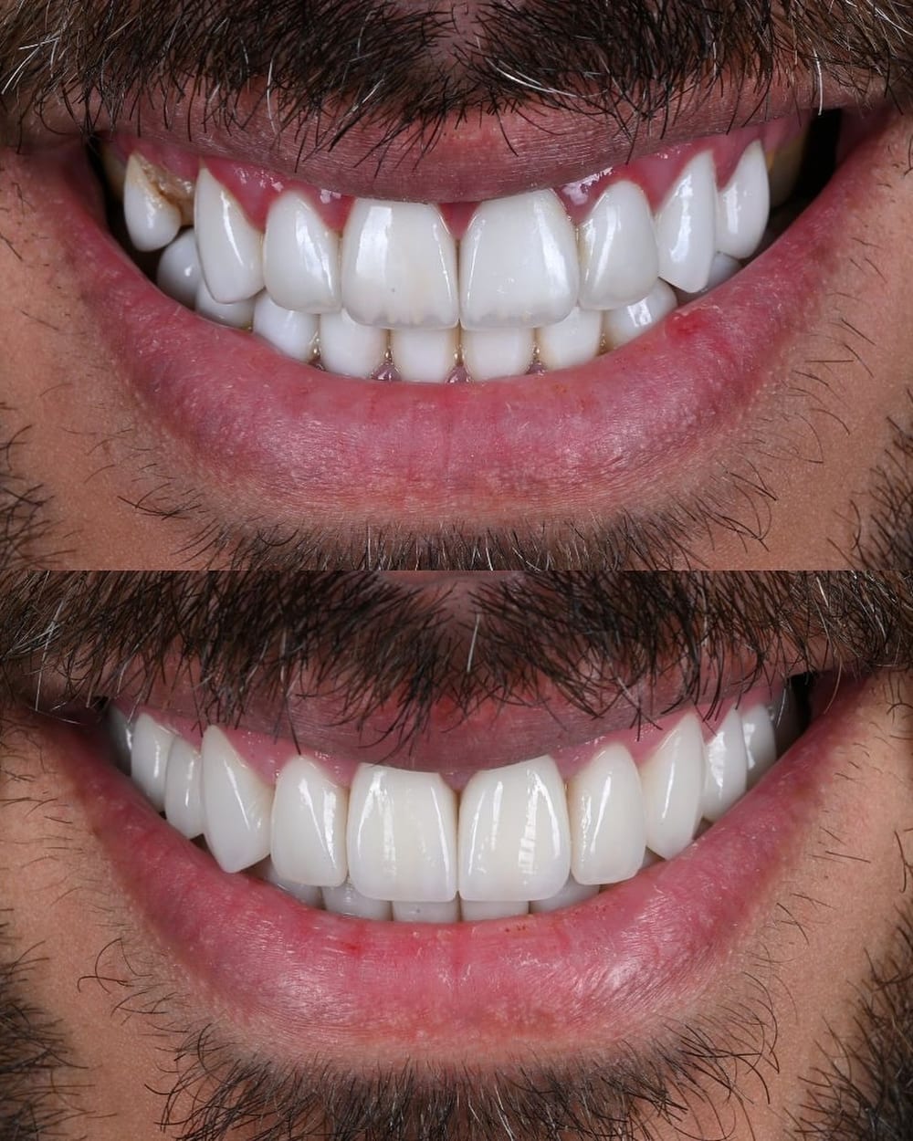 Before and after smile photo from a patient at Creative Arts Dubai
