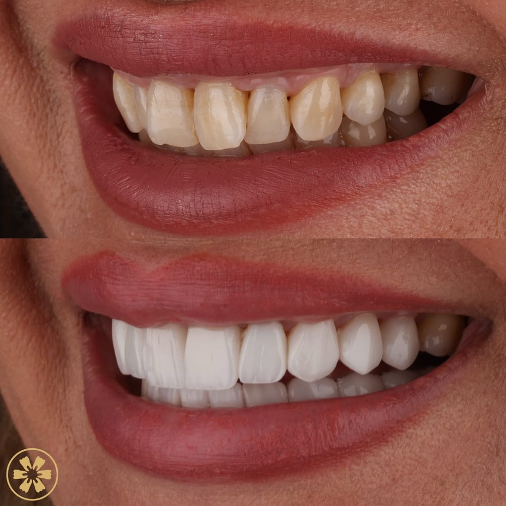 Before and after smile photo from a patient at Creative Arts Dubai