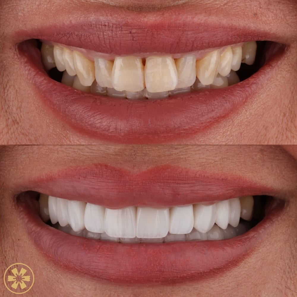 Before and after smile photo from a patient at Creative Arts Dubai