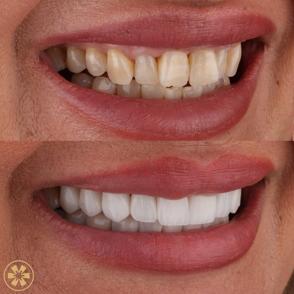 Before and after smile photo from a patient at Creative Arts Dubai