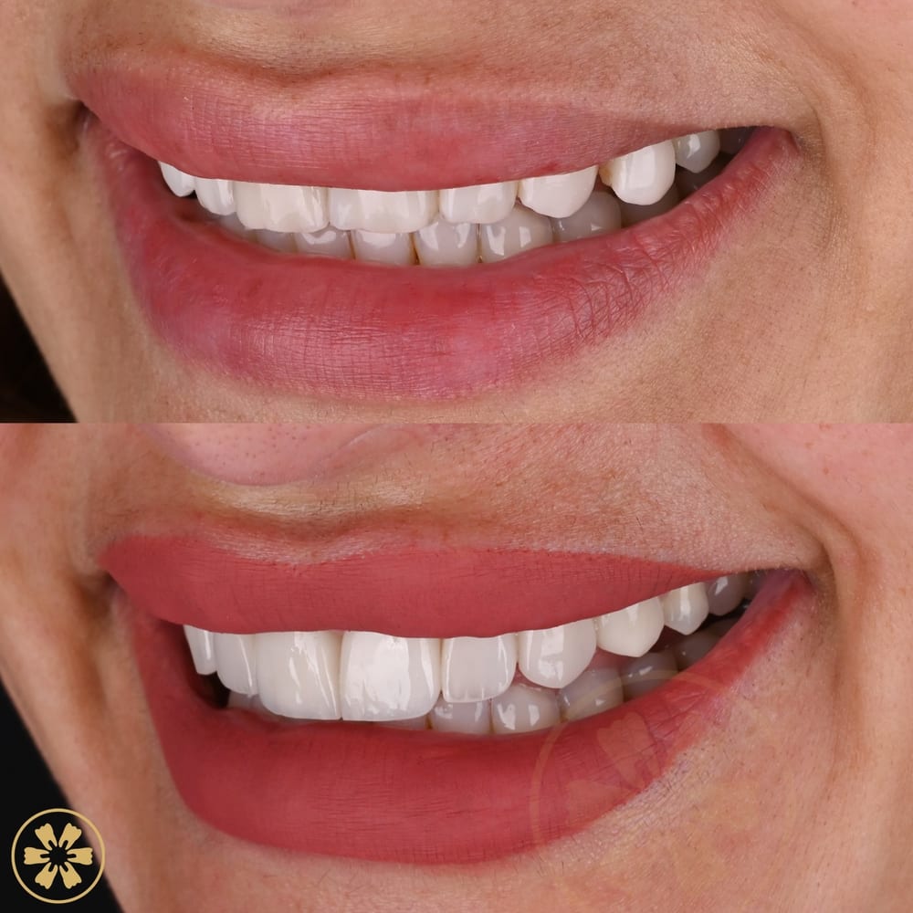 Before and after smile photo from a patient at Creative Arts Dubai