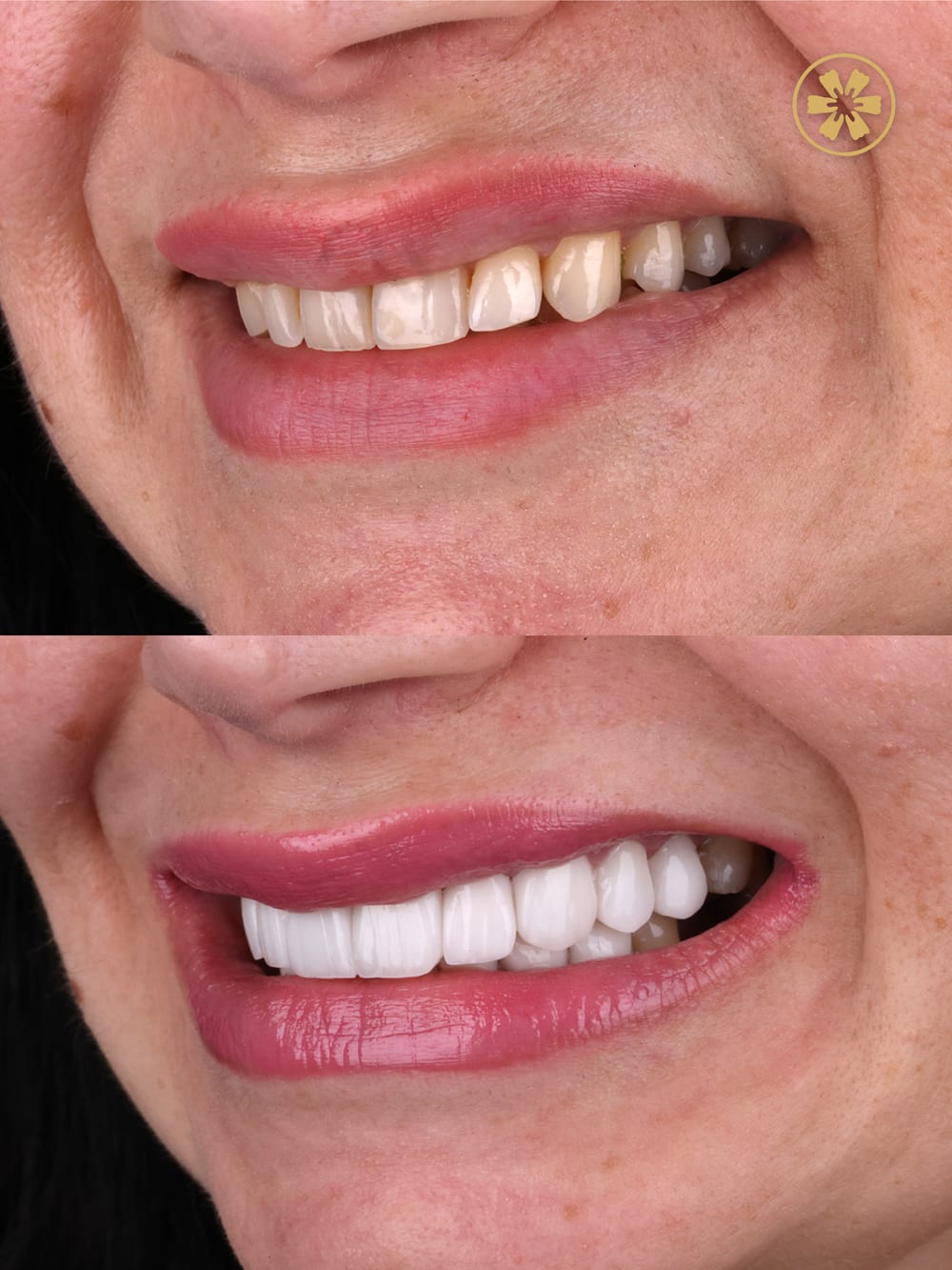 Before and after smile photo, treated by Dr. Khalid Saeed at Creative Arts Dubai