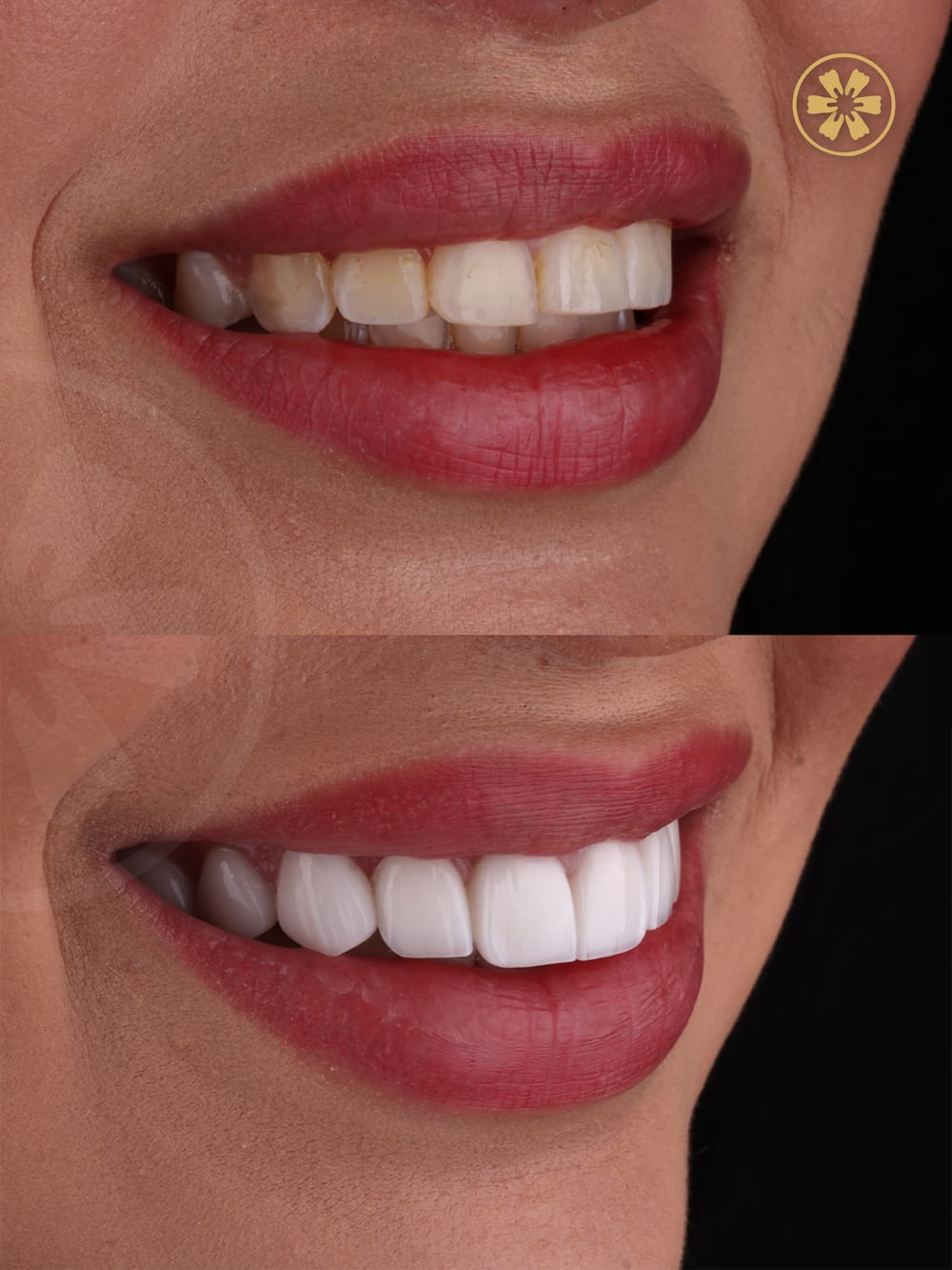 Before and after smile photo from a patient at Creative Arts Dubai