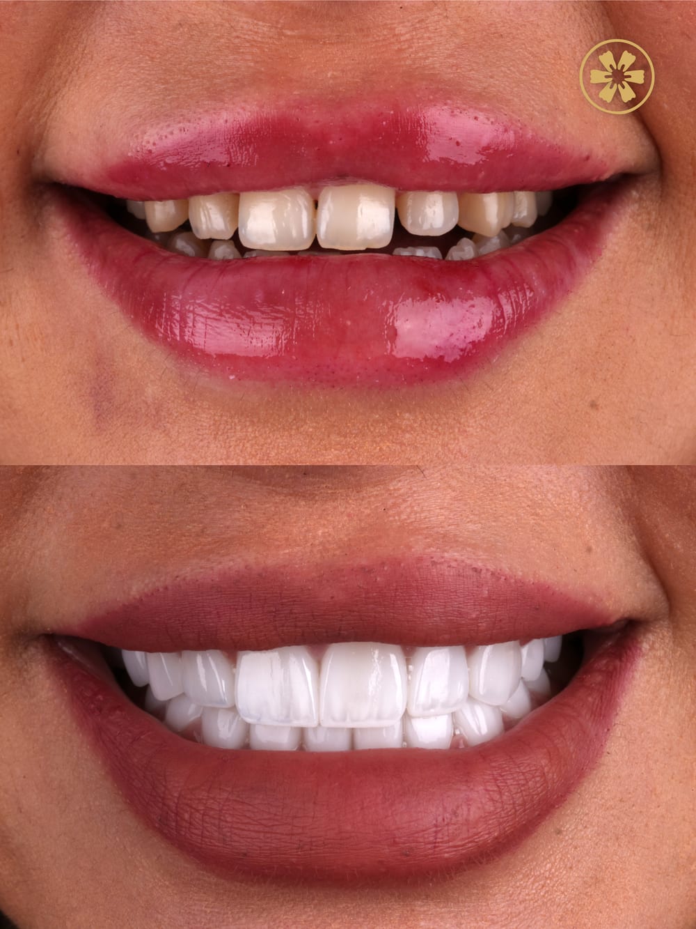 Before and after smile photo from a patient at Creative Arts Dubai
