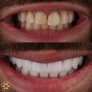 Before and after view 1 of Ahmad's porcelain veneers treatment in Dubai