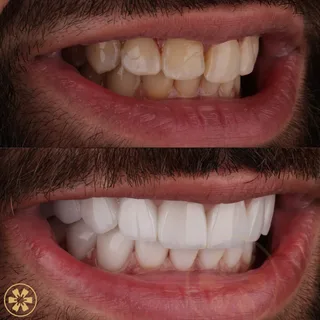 Before and after view 2 of Ahmad's porcelain veneers treatment in Dubai