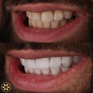 Before and after view 3 of Ahmad's porcelain veneers treatment in Dubai