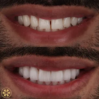 Before and after view 1 of Daneal's smile makeover treatment in Dubai