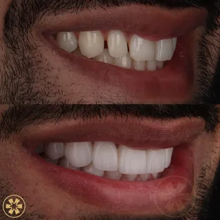 Before and after view 2 of Daneal's smile makeover treatment in Dubai