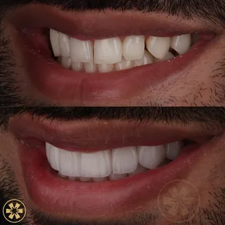 Before and after view 3 of Daneal's smile makeover treatment in Dubai