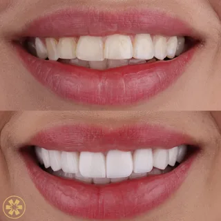 Before and after view 1 of Nataly's hollywood smile treatment in Dubai