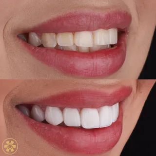 Before and after view 2 of Nataly's hollywood smile treatment in Dubai