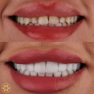 Before and after view 1 of Shahed's porcelain veneers treatment in Dubai