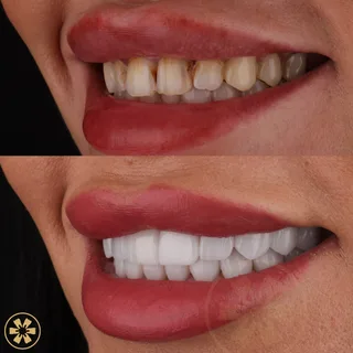 Before and after view 2 of Shahed's porcelain veneers treatment in Dubai