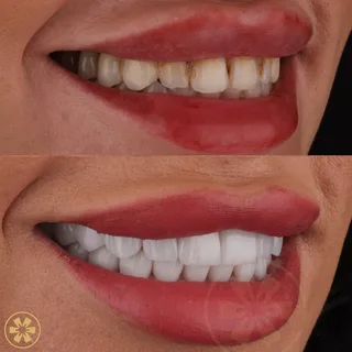 Before and after view 3 of Shahed's porcelain veneers treatment in Dubai